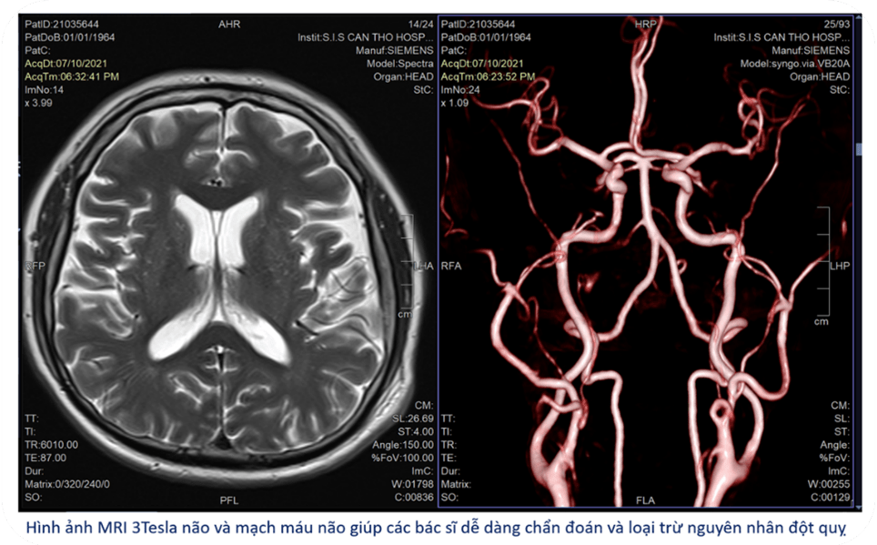 Hình anh MRI não bn H.V.D Cứu sống bệnh nhân hôn mê sâu bằng hồi sức tích cực 