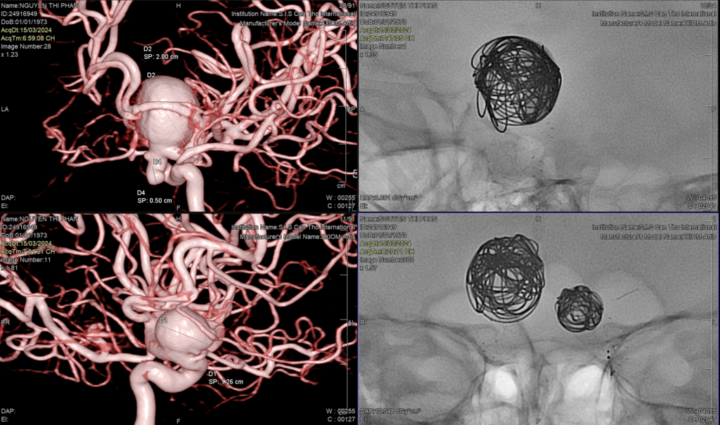 TIN VUI ĐÃ CAN THIỆP THÀNH CÔNG CHO CHỊ NGUYỄN THỊ PHẬN