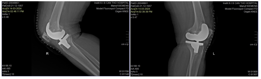 Thay toàn bộ 2 gối chỉ 1 lần mổ duy nhất