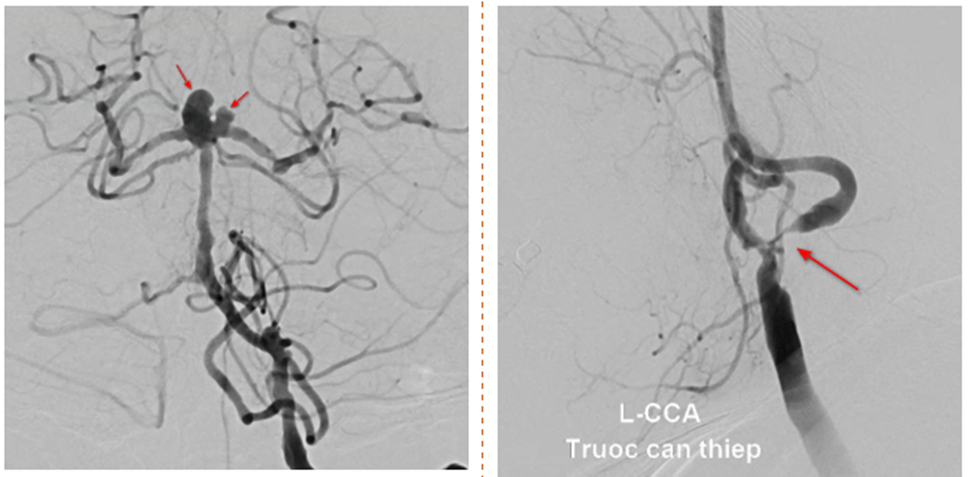 Can thiệp thành công túi phình mạch máu não cổ rộng 2 thùy