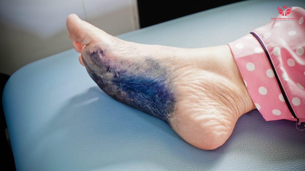 Bệnh Đái Tháo Đường và Những Sai Lầm Cần Tránh