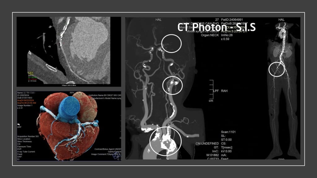 Phát hiện xơ vữa đóng vôi mạch máu toàn thân nhờ công nghệ chụp CT photon