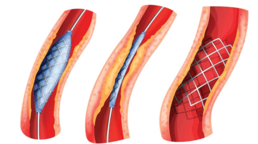 Sau đặt stent mạch vành, bệnh nhân cần lưu ý gì?