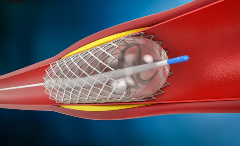 Sau đặt stent mạch vành, bệnh nhân cần lưu ý gì?