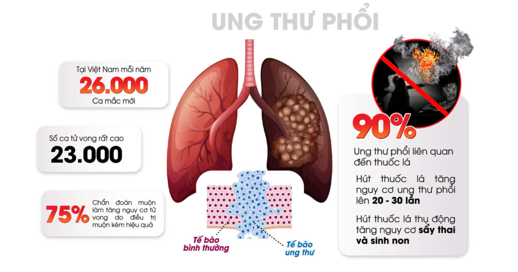 Ung thư phổi ngày càng trẻ hóa: Nguyên nhân, dấu hiệu và cách phát hiện sớm
