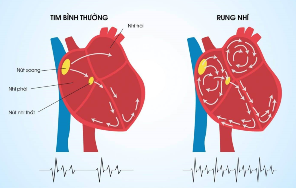 3 mục tiêu điều trị hiệu quả bệnh rung nhĩ