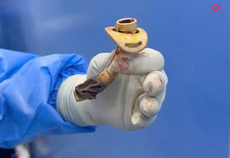 “Giải cứu” người phụ nữ U70 mang “vật bất ly thân” suốt 7 năm