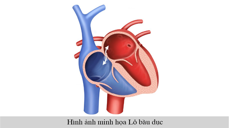 Bít lỗ bầu dục trong tim phòng ngừa đột quỵ não vô căn tái phát