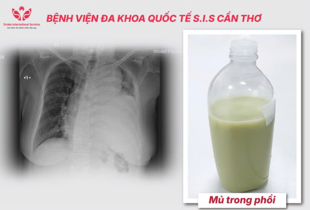 ĐAU NGỰC KHÔNG PHẢI LÚC NÀO CŨNG LÀ BỆNH TIM!