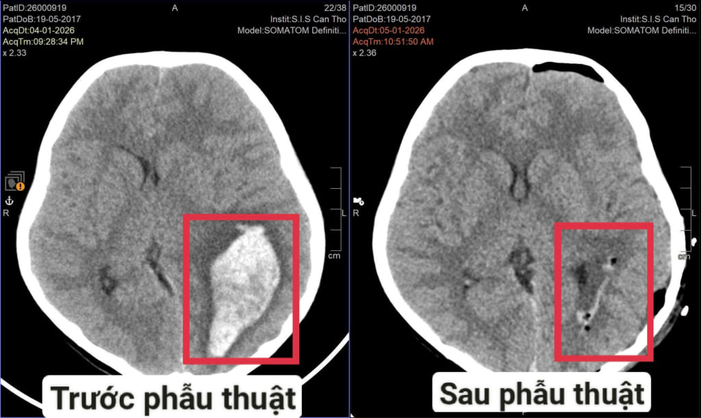 Cứu sống trẻ xuất huyết não do vỡ dị dạng mạch máu não