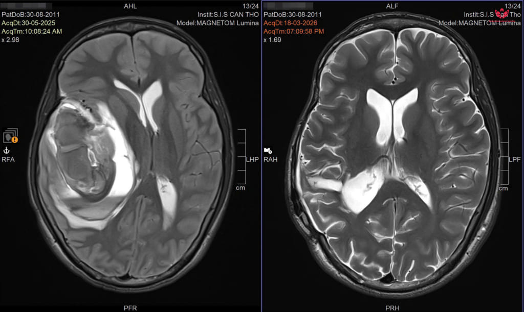 Giữ lại giấc mơ làm họa sĩ cho nam sinh lớp 8 sau cơn xuất huyết não nguy kịch
