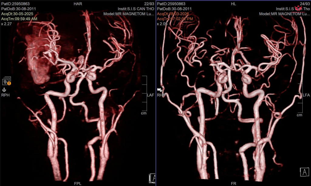 Giữ lại giấc mơ làm họa sĩ cho nam sinh lớp 8 sau cơn xuất huyết não nguy kịch