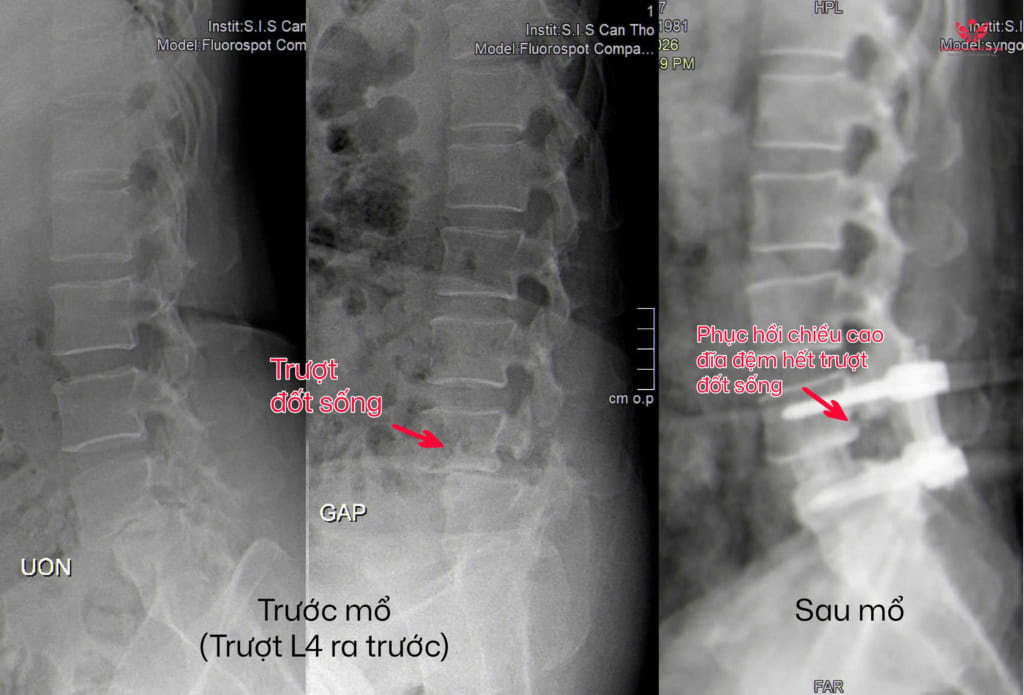 Cứu bệnh nhân trật đốt sống sau té ngã bằng phẫu thuật nội soi cố định xương
