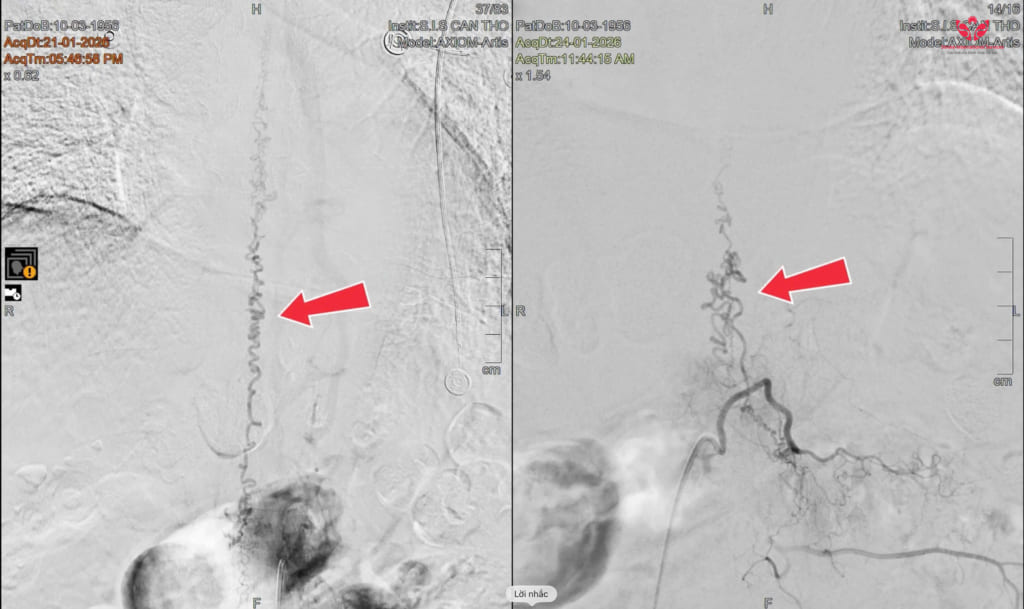 Suýt liệt vì bệnh hiếm bị nhầm với đau thần kinh tọa