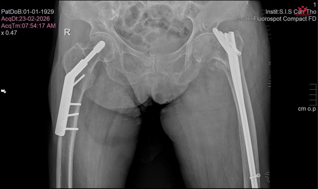 Té gãy xương ở tuổi 97, cụ bà được phẫu thuật giúp phục hồi vận động