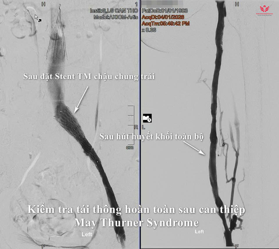 Đứng làm việc 10 tiếng mỗi ngày, nữ công nhân suýt mất chân vì huyết khối