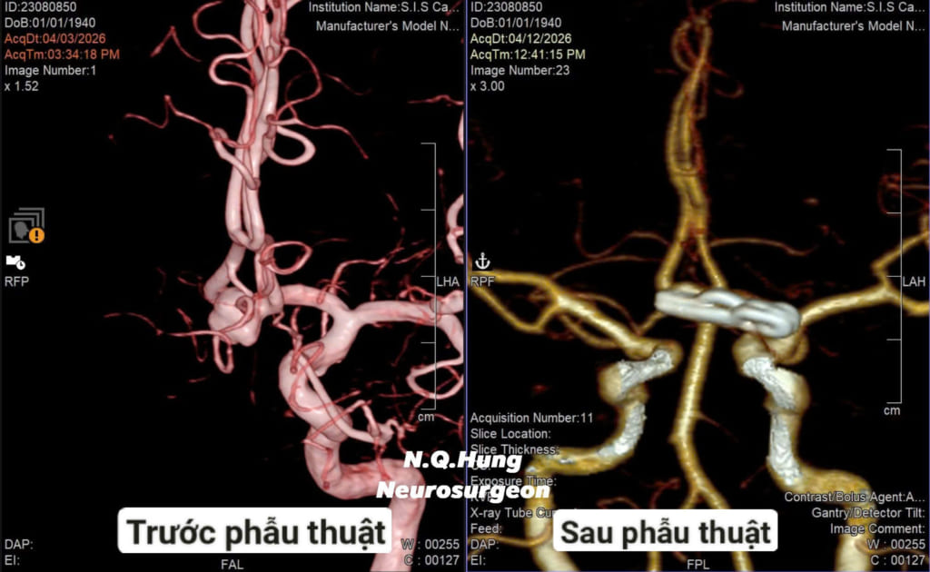 Cứu cụ bà 86 tuổi mang túi phình động mạch não như “bom hẹn giờ”