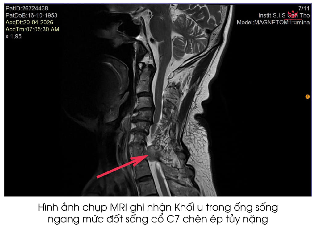Tê tay, yếu chân không dứt: Cảnh báo bệnh lý nguy hiểm dễ bị nhầm với đột quỵ