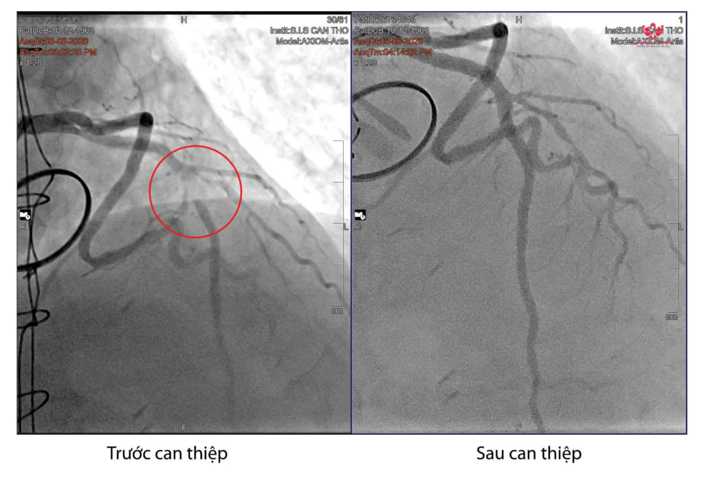 Hai cầu nối mạch vành tắc hoàn toàn sau 15 năm, bệnh nhân được cứu bằng 4 stent tại S.I.S Cần Thơ