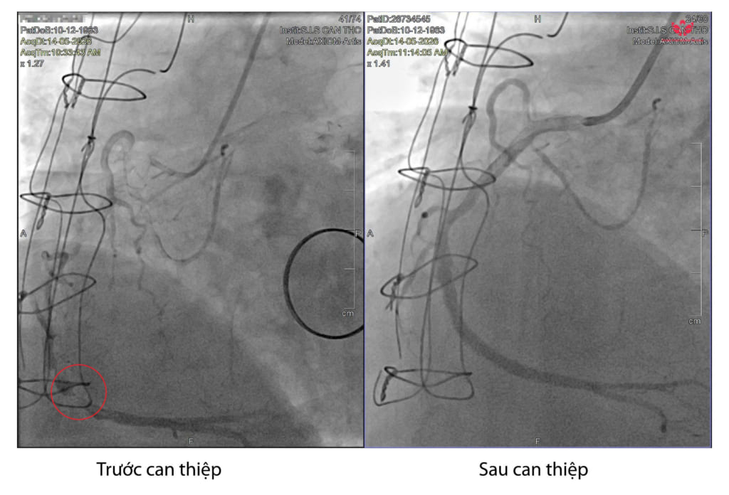 Hai cầu nối mạch vành tắc hoàn toàn sau 15 năm, bệnh nhân được cứu bằng 4 stent tại S.I.S Cần Thơ