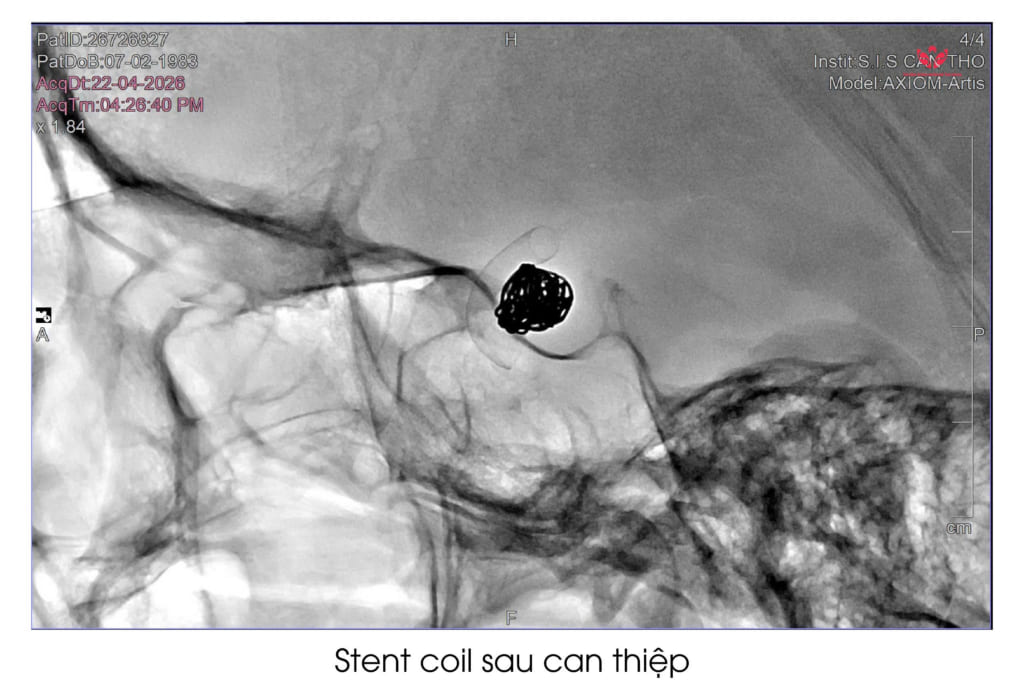 Bất ngờ phát hiện túi phình mạch máu não khi đi tầm soát sức khỏe