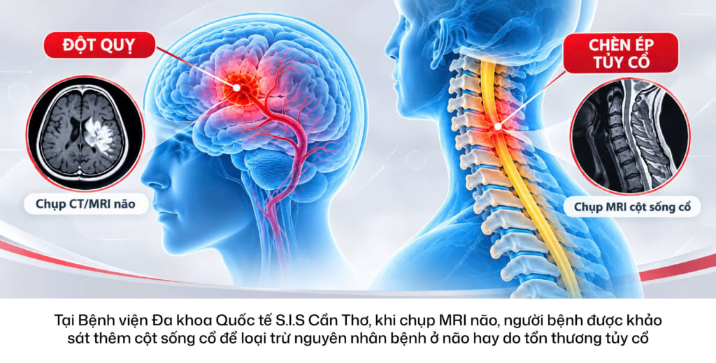 Chèn ép tủy cổ: Bệnh lý dễ bị nhầm với đột quỵ