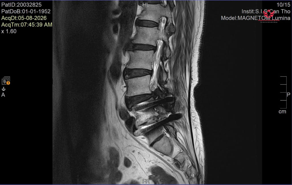 S.I.S phẫu thuật nội soi xử lý tổn thương tầng kế cận sau cố định cột sống