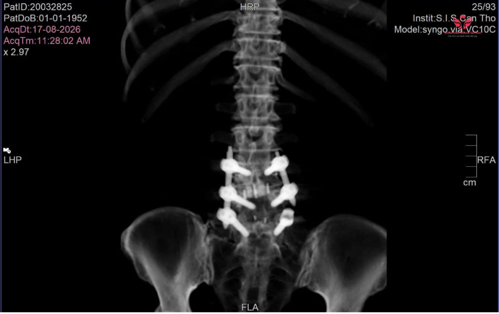 S.I.S phẫu thuật nội soi xử lý tổn thương tầng kế cận sau cố định cột sống